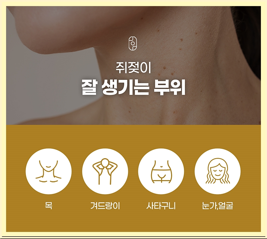 창원쥐젖제거 쥐젖이 잘 생기는 부위 정리 이미지