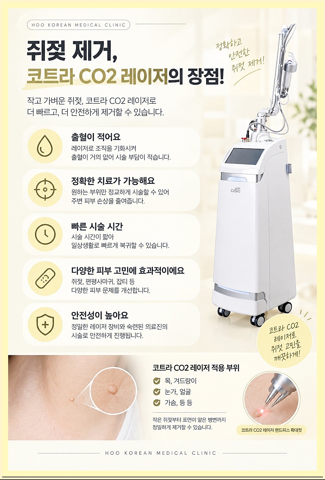 창원쥐젖제거 코트라 레이저 장점