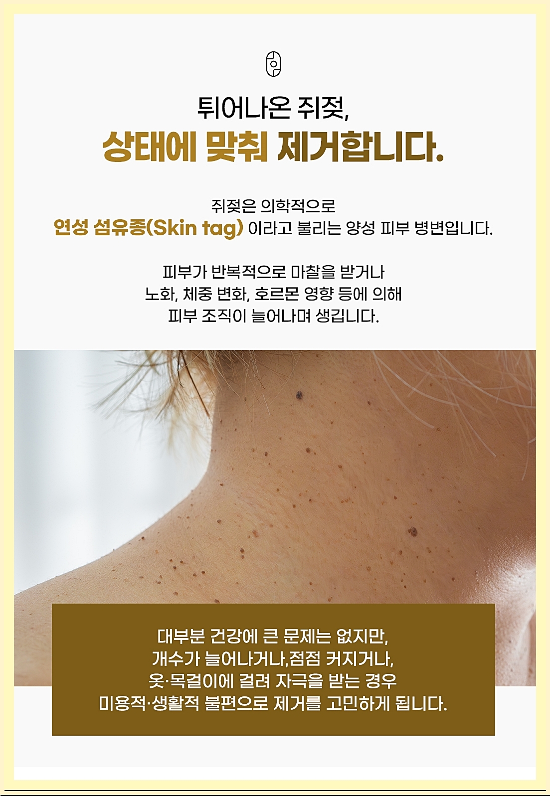 창원쥐젖제거 상태에 맞춘 치료 이미지