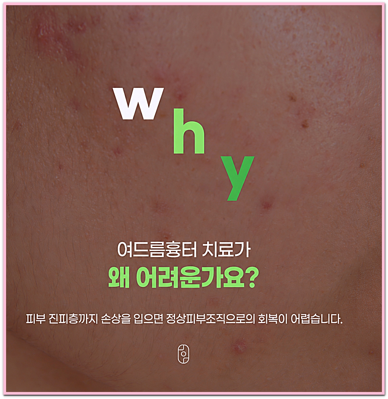 여드름흉터 치료가 어려운 이유, 피부 진피층까지 손상되면 정상 피부조직으로 회복이 어렵다