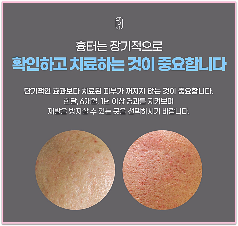 창원여드름흉터 치료는 한 달, 6개월, 1년 이상 장기적으로 경과를 확인