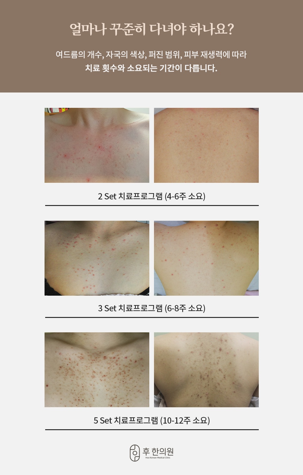 2세트 4~6주, 3세트 6~8주, 5세트 10~12주로 나눈 등가슴여드름 치료 횟수 안내