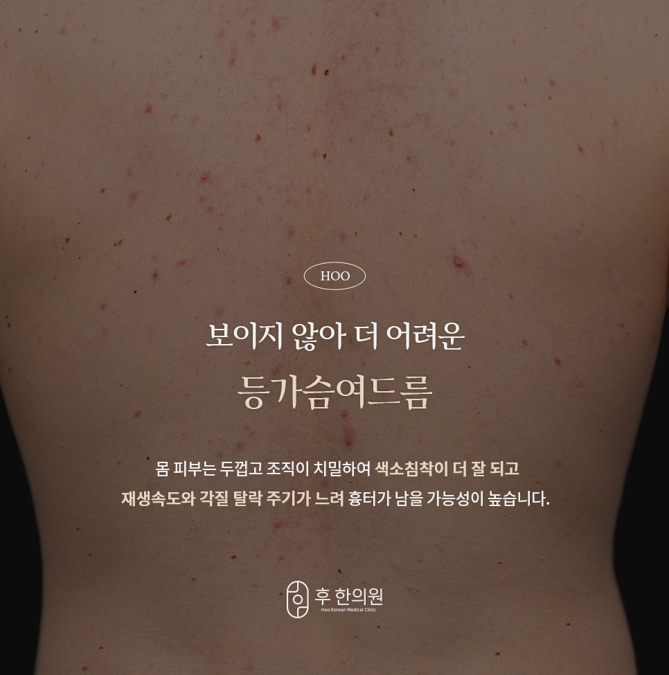 몸 피부가 두꺼워 색소침착이 잘 되고 흉터가 남기 쉬운 등가슴여드름 안내