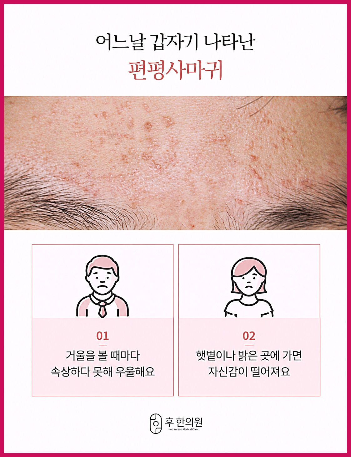 창원편평사마귀 제거 전 확인하는 이마의 편평사마귀 모습과 고민 사례 